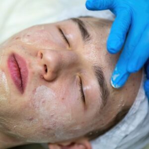 Acne Facial