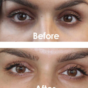 Nurture & Glow Facial plus Carboxy Treatment